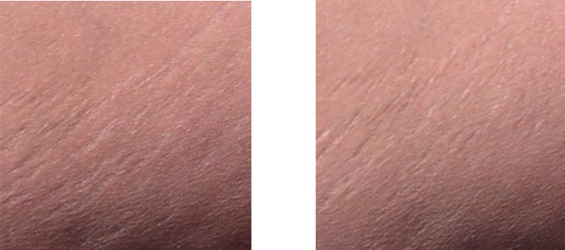 Provital launches Striover, an ingredient that tackles stretch marks