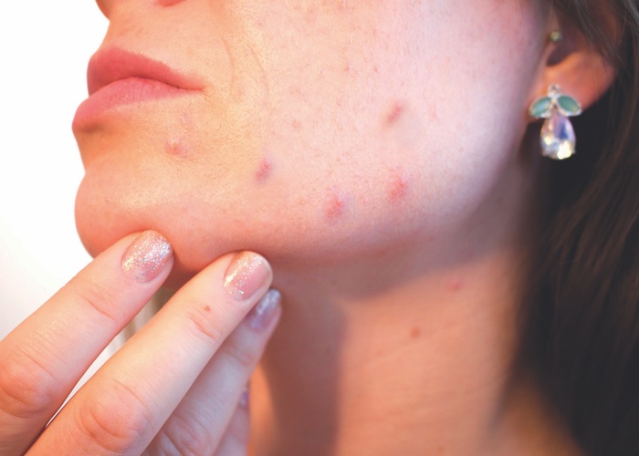 Scientists discover acne in teens could be natural 
