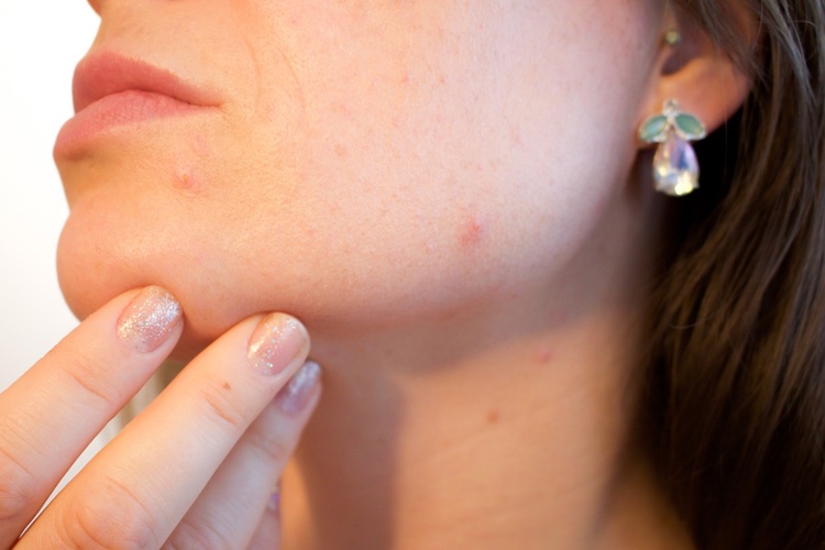 Scientists move closer to developing acne vaccine