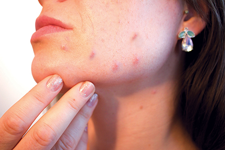 Seppic offers hope for acne-prone skins