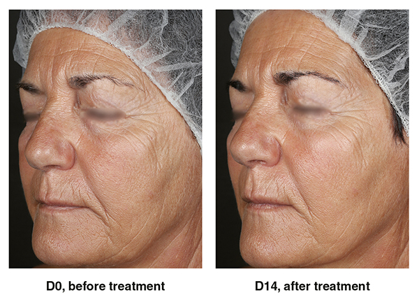 Silab’s new ingredient reactivates the endogenous processes of desquamation