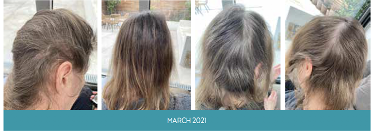 Simone Thomas Wellness assesses the damage that Covid-19 has had on hair loss