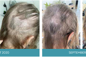 Simone Thomas Wellness assesses the damage that Covid-19 has had on hair loss