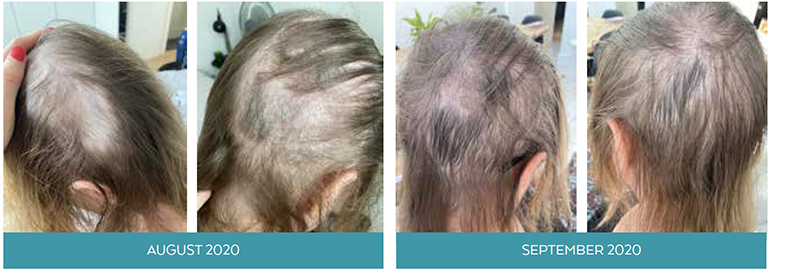 Simone Thomas Wellness assesses the damage that Covid-19 has had on hair loss