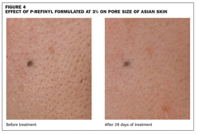 Skin care – The refinement of pores