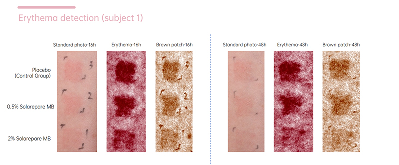 Sun-damaged skin treatment: Solarepare MB offers dual protection from sunburn