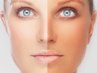 Tanning addicts more likely to be dependent on alcohol 

