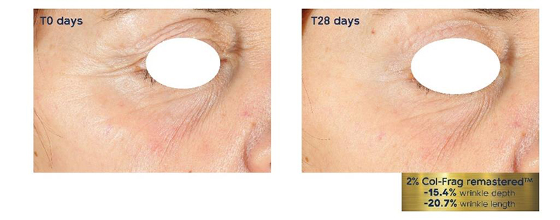 The beginning of a new collagen era 
