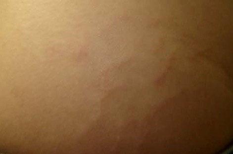 Vanistryl banishes stretch marks 