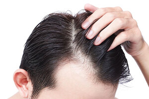What is male pattern baldness?