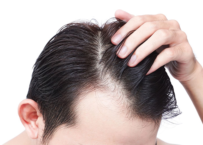 What is male pattern baldness?