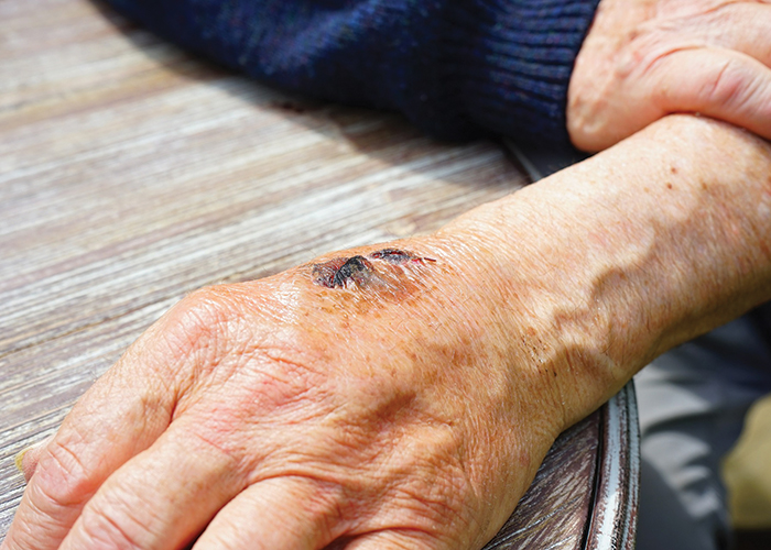 What is scar tissue?